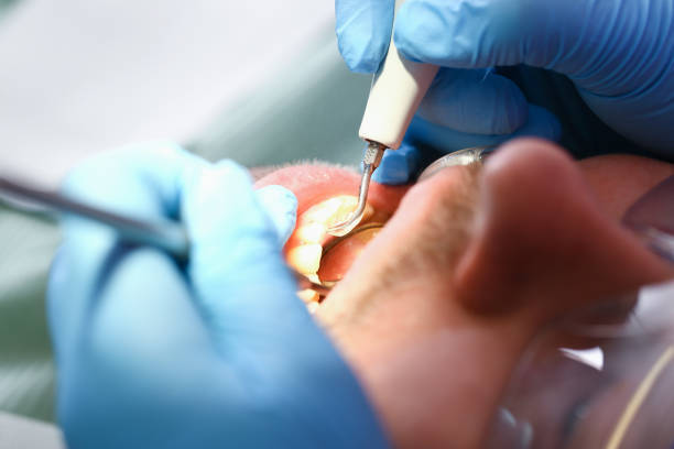 Best Emergency Care for Gum Disease in Aliso Viejo, CA